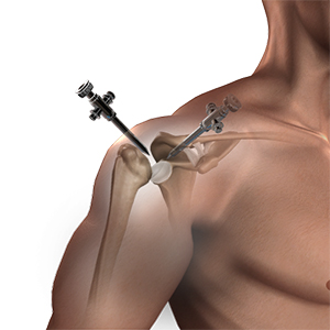 Shoulder Labrum