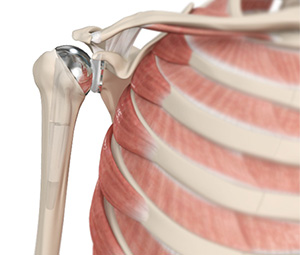 Total Shoulder Replacements