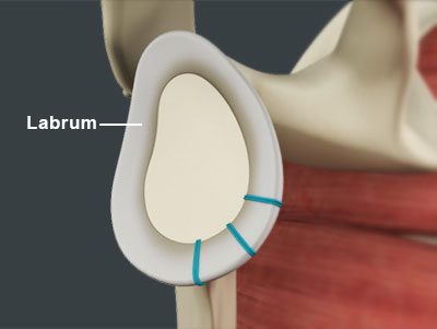 Shoulder Labrum Reconstruction